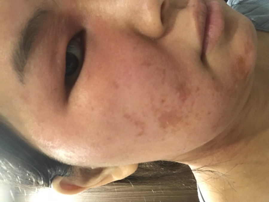 肌荒れに悩んでいた頃のえりかの頬