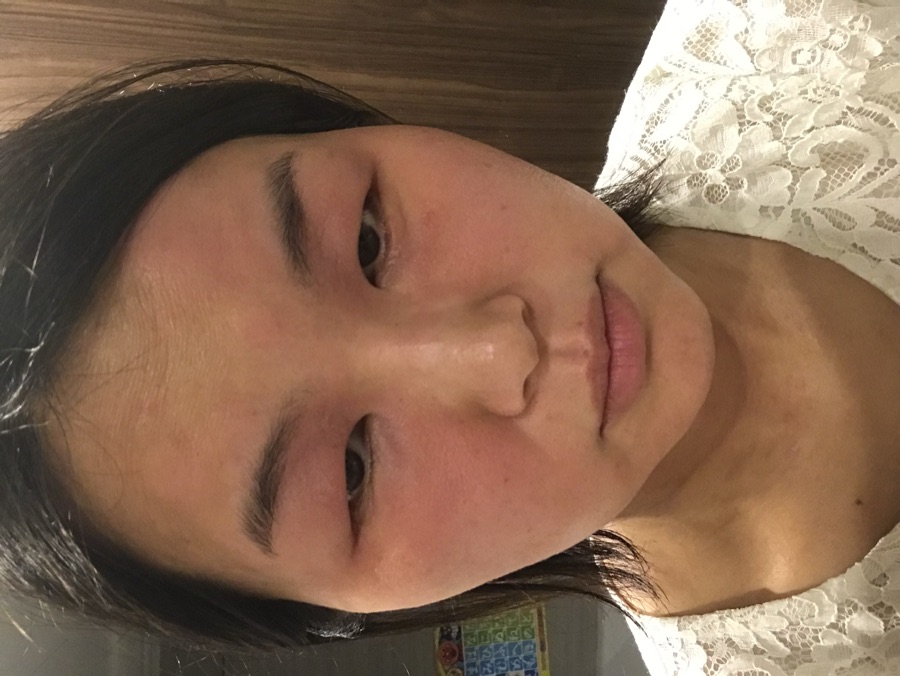 肌荒れに悩んでいた頃のえりか